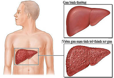 Đừng để viêm gan làm giảm chất lượng sống - 1