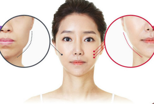 Những phương pháp phẫu thuật thẩm mỹ được chú ý nhất 2015 - 4