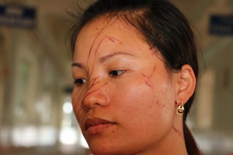 Hai mẹ con bị hàng xóm rạch mặt dã man - 1