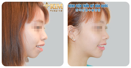 Phẫu thuật hàm hô móm không niềng răng: giải pháp cho nụ cười kém duyên - 2