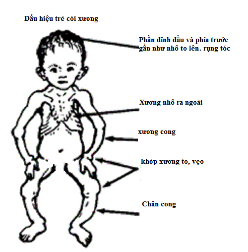 Cách phòng chống bệnh còi xương ở tuổi thiếu niên: Giải pháp hiệu quả giúp trẻ phát triển khỏe mạnh