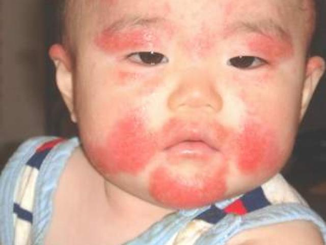 3 mẹo dân gian trị bệnh chàm ở trẻ sơ sinh không phải mẹ nào cũng biết