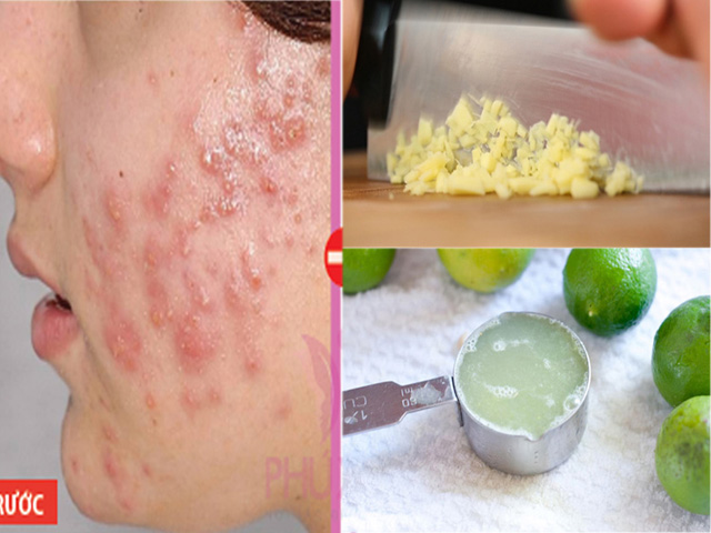 Mụn mủ, mụn bọc sưng viêm đến mấy cũng sẽ xẹp ngay sau một đêm