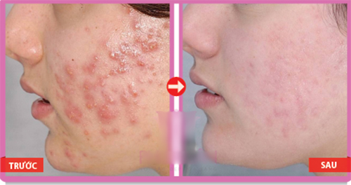 Mụn mủ, mụn bọc sưng viêm đến mấy cũng sẽ xẹp ngay sau một đêm - 1