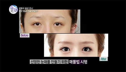 Cặp song sinh hot nhất tuần: Màn lột xác ngoạn mục nhờ phẫu thật thẩm mỹ - 6