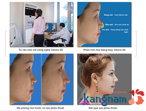 Chuyên khoa thẩm mỹ mũi ưu đãi 20% cho phái đẹp trong tháng 10 - 2