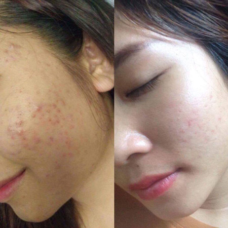 Không còn lo mụn với Sắc Mộc Hương - 3