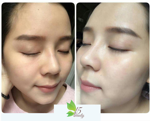 Cấy phấn cho da – Không cần trang điểm vẫn đẹp rạng ngời - 4