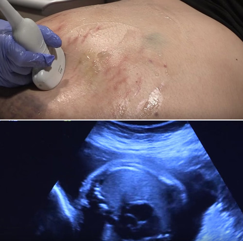 Mới mang bầu đã thấy nhiều vết thâm tím, bà mẹ ‘sốc nặng’ khi nhận tin từ bác sĩ - 1