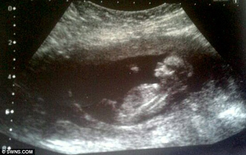Bức ảnh siêu âm bụng sau sảy thai khiến bà mẹ sững người