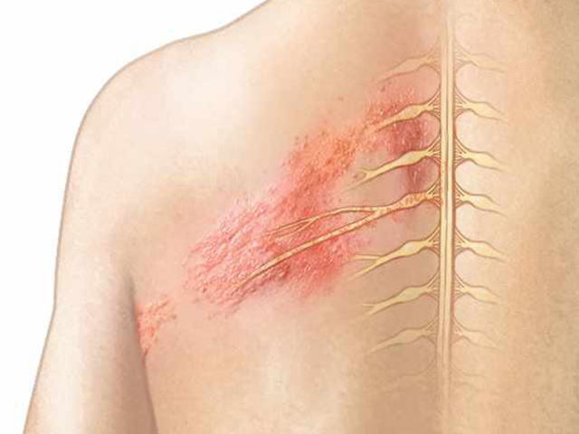 Cách phân biệt vết zona thần kinh, giời leo và kiến 3 khoang cắn