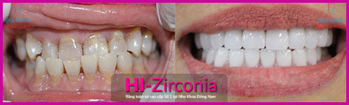 Nha Khoa Đông Nam ra mắt răng sứ cao cấp HI–Zirconia - 2
