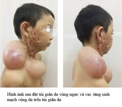 Cháu bé 9 tuổi nổi sẹo lồi khổng lồ do bỏng cồn đã có khuôn mặt mới - 1