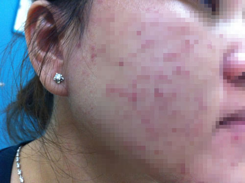 Làm đẹp “khác người”, cô gái trẻ nhập viện với khuôn mặt biến dạng - 1
