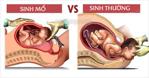 7 bí mật về sinh mổ mà ít ai nói cho mẹ bầu biết - 2