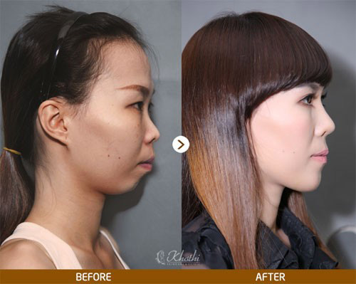 Sao châu Á đổi vận nhờ nâng mũi - 4