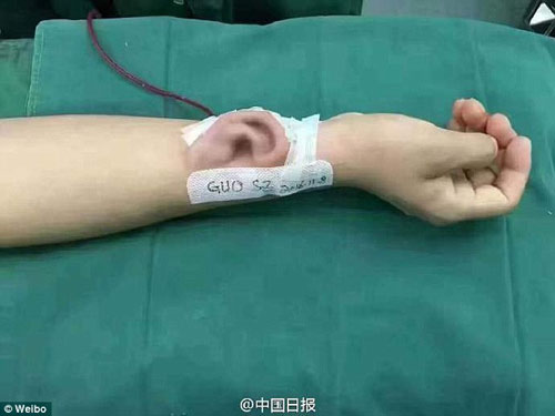 Khó tin: Mất tai, được #039;trồng#039; tai giả ở... cánh tay - 3