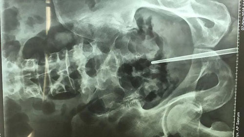 Chàng trai TQ bị mắc kẹt chiếc đũa dài trong quot;của quýquot; khi tự khám bệnh - 1