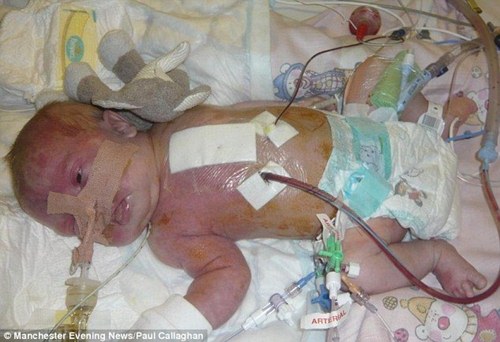 Khuôn mặt khác lạ sau phẫu thuật của bé gái bị chàm trên mặt - 2