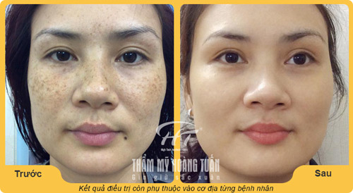 Hàng nghìn cơ hội trị nám, tàn nhang miễn phí - 3