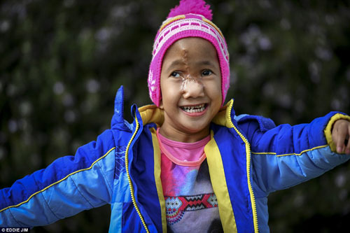 Bé 4 tuổi bị gọi là #039;quái vật#039; đã thay đổi cuộc sống diệu kỳ sau ca phẫu thuật - 3