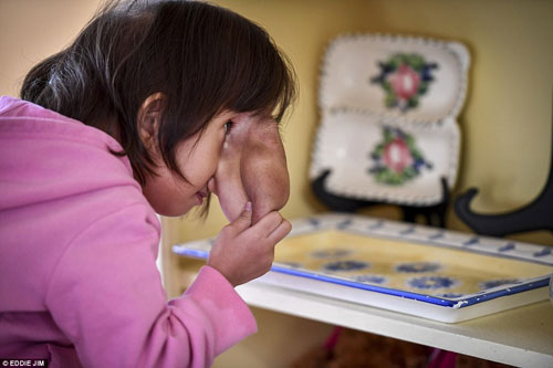 Bé 4 tuổi bị gọi là #039;quái vật#039; đã thay đổi cuộc sống diệu kỳ sau ca phẫu thuật - 2