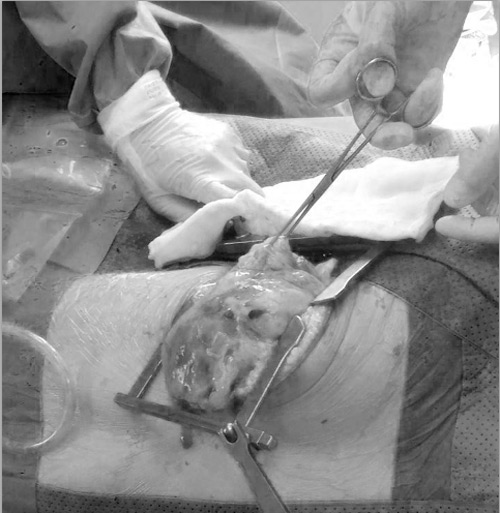 Nam thanh niên 18 tuổi mang khối u nặng 7kg trong lồng ngực - 1