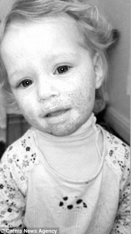 #039;Nụ hôn thần chết#039; khiến bé gái 2 tuổi bị lở loét, đau đớn suốt 8 tháng trời - 1