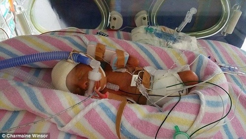 Hình ảnh 7 ngày cuối cùng của bé trai mắc hội chứng truyền máu song thai gây xúc động - 3