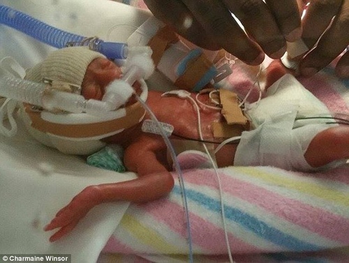 Hình ảnh 7 ngày cuối cùng của bé trai mắc hội chứng truyền máu song thai gây xúc động - 5
