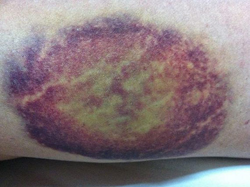 Cảnh giác với nốt bầm tím trên cơ thể: Có thể là dấu hiệu bệnh nguy hiểm - 1