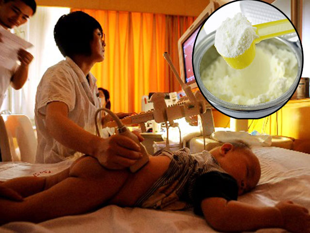 Bé 2 tuổi đã sỏi thận, bác sĩ sau khi khám mắng bố mẹ té tát vì lỗi pha sữa sai lầm