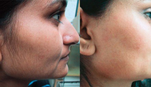 Mặt nạ thần kỳ tẩy sạch lông và mụn đầu đen trên mặt ngay tức khắc - 5