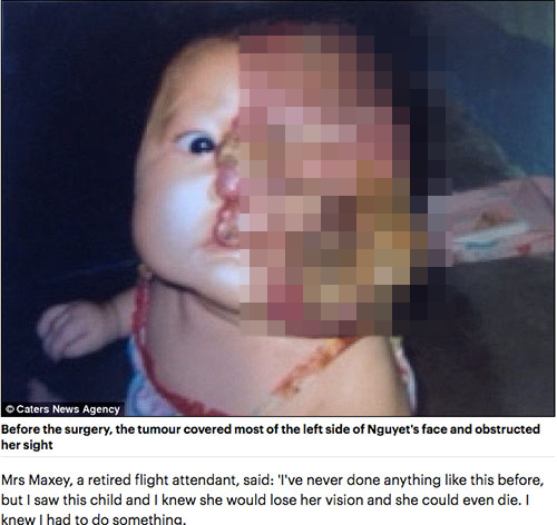 Cuộc sống mới của bé Việt mang khối u nửa khuôn mặt được nhà hảo tâm người Mỹ cứu sống - 1