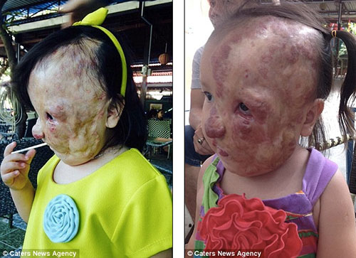 Cuộc sống mới của bé Việt mang khối u nửa khuôn mặt được nhà hảo tâm người Mỹ cứu sống - 3