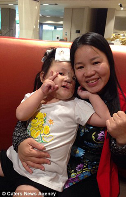 Cuộc sống mới của bé Việt mang khối u nửa khuôn mặt được nhà hảo tâm người Mỹ cứu sống - 5