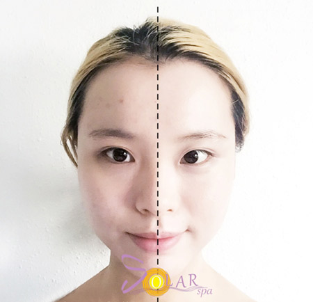 Phun trắng da vi kim hiệu quả chỉ sau 1 liệu trình - 3