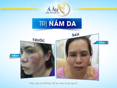 Làm sao sạch nám sáng da, đón đầu vận may mừng năm mới? - 4