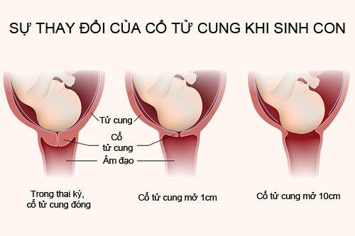 4. Các biện pháp giúp cổ tử cung mở nhanh hơn