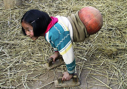 Bé gái tàn tật có nửa thân dưới là một quả bóng rổ khi lớn khiến triệu người ngưỡng mộ