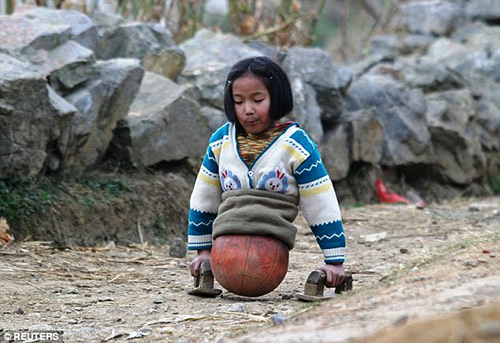 Bé gái tàn tật có nửa thân dưới là một quả bóng rổ khi lớn khiến triệu người ngưỡng mộ
