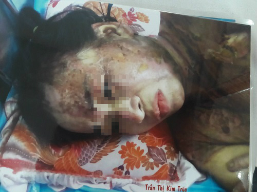Không chịu móc cống tắc, người phụ nữ bị đồng nghiệp tạt nguyên cả nồi thịt kho đang sôi - 1