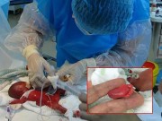 Bà bầu - Kỳ tích sống sót của em bé sinh non nhất thế giới, nặng chưa đến 5 lạng, da trong suốt