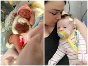 Làm mẹ - Chào đời với phần ruột nằm ngoài bụng, bé sơ sinh sống sót nhờ quấn màng bọc thực phẩm