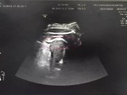 Bà bầu - Mẹ bầu 8 tháng suýt mất mạng vì thai nhi đạp thủng tử cung, chân thò ra ngoài