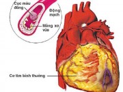 Sức khỏe - Cảnh giác đột quỵ não khi giao mùa