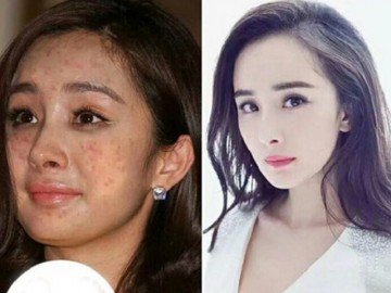 Ngôi sao 24/7: Sự thật đằng sau gương mặt chi chít mụn đến phát sợ của Dương Mịch