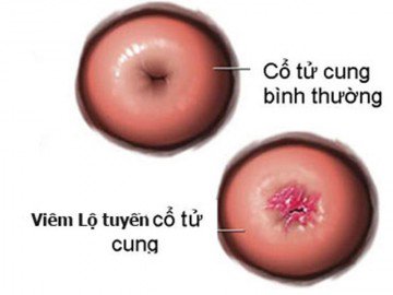 Viêm lộ tuyến cổ tử cung và nguy cơ hiếm muộn