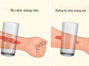 Làm mẹ - 8 dấu hiệu viêm màng não ở trẻ đáng báo động, bố mẹ cần lưu ý