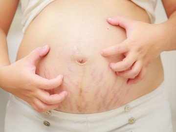 4 dấu hiệu sớm báo bạn chắc chắn sẽ bị rạn bụng khi mang thai